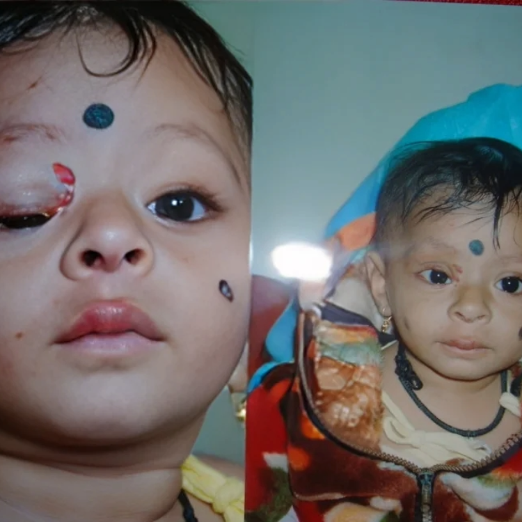 Oculoplasty-3